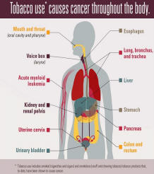 A picture showing how tobacco cause cancer