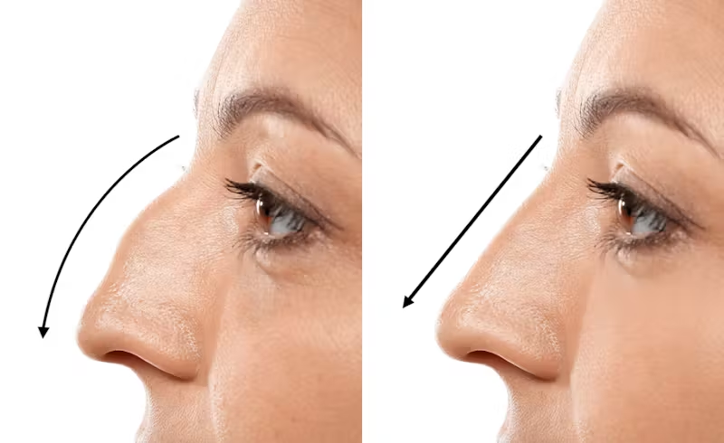 Rhinoplasty