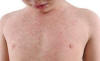 Boy with chest allergy
